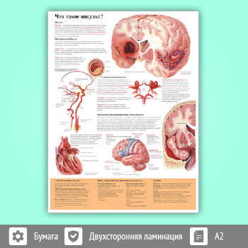 Плакат «Что такое инсульт» (ЗОЖ-13, 1 лист, A2)